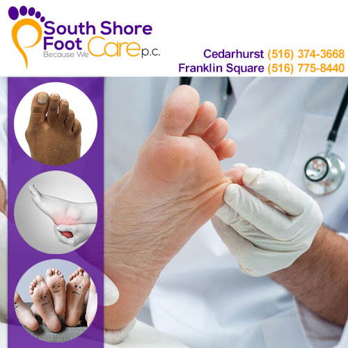 Ankle Sprains Treatment  Foot Doctor, Certified Pedorthist South Carolina