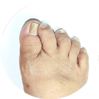 Hammertoe and mallet toe treatment in the Nassau County, NY area: Cedarhurst, NY 11516 and Franklin Square, NY 11010