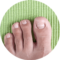 Ingrown Toenail Treatment in the Nassau County, NY area: Cedarhurst, NY 11516 and Franklin Square, NY 11010