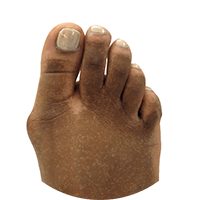 Bunion Surgery in the Nassau County, NY area: Cedarhurst, NY 11516 and Franklin Square, NY 11010